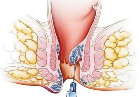 Bệnh trĩ có những phương pháp điều trị nào?